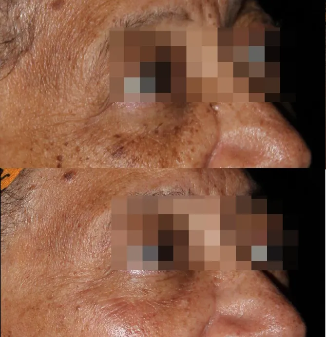 Skin Rejuvenation Solutions before and after at Glowtique Brisbane