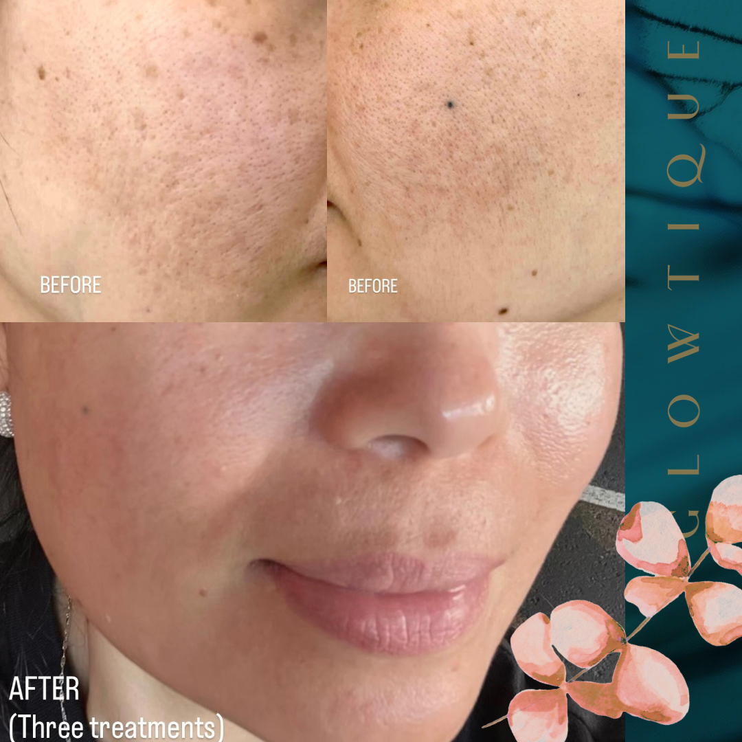 Skin Rejuvenation Solutions before and after at Glowtique Brisbane