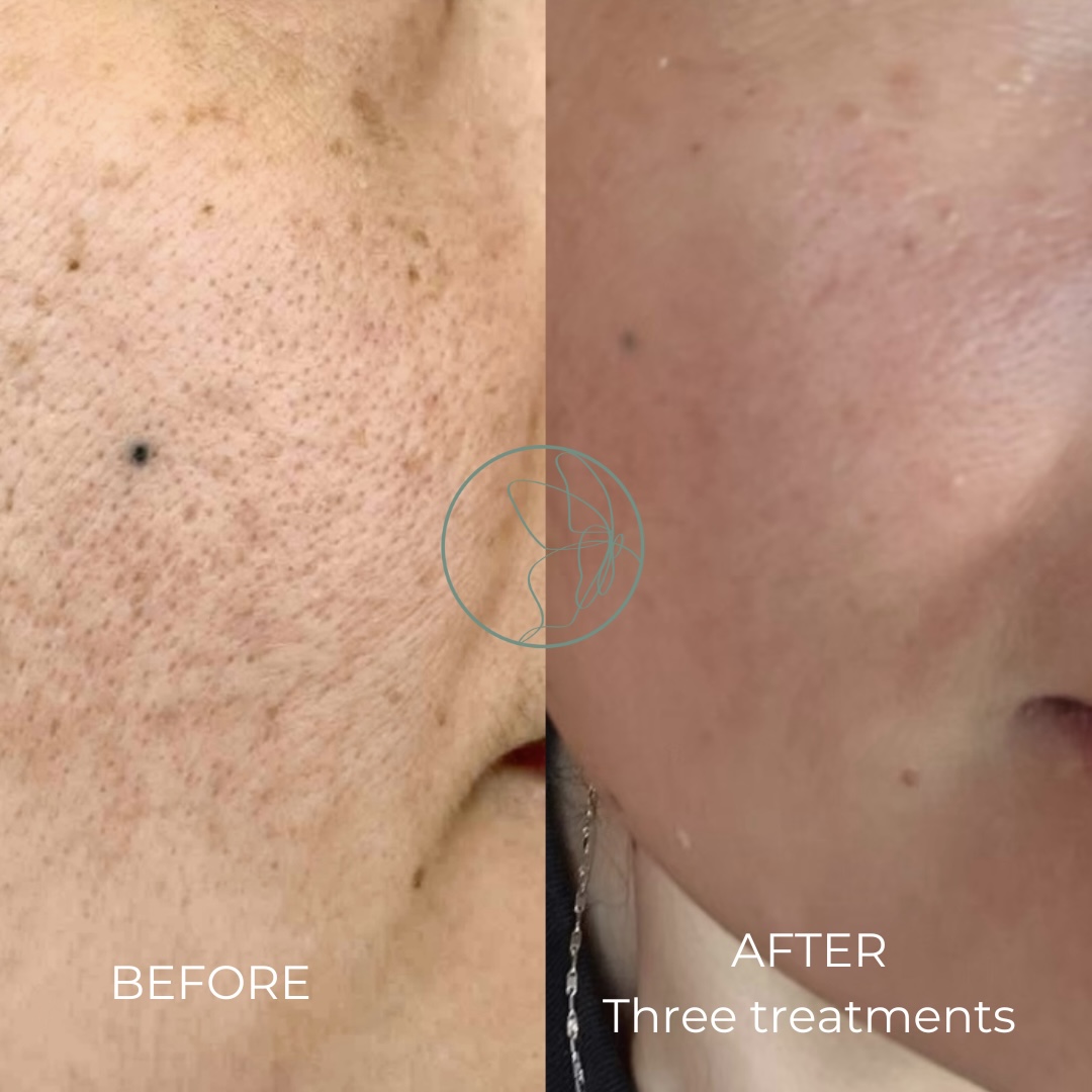 Skin Rejuvenation Solutions before and after at Glowtique Brisbane