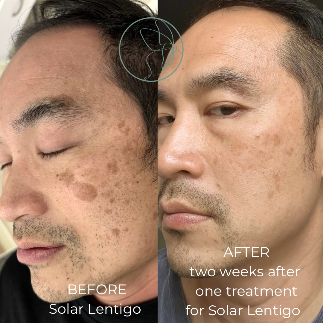 Skin Rejuvenation Solutions before and after at Glowtique Brisbane
