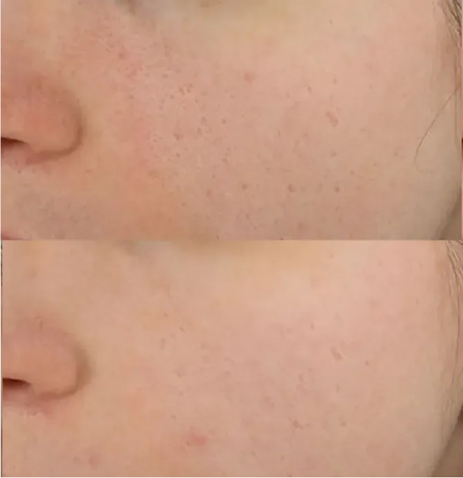 Skin Smoothening before and after at Glowtique Brisbane