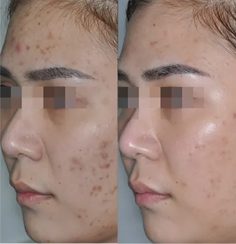 Skin Smoothening before and after at Glowtique Brisbane