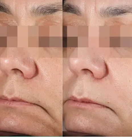 Skin Smoothening before and after at Glowtique Brisbane