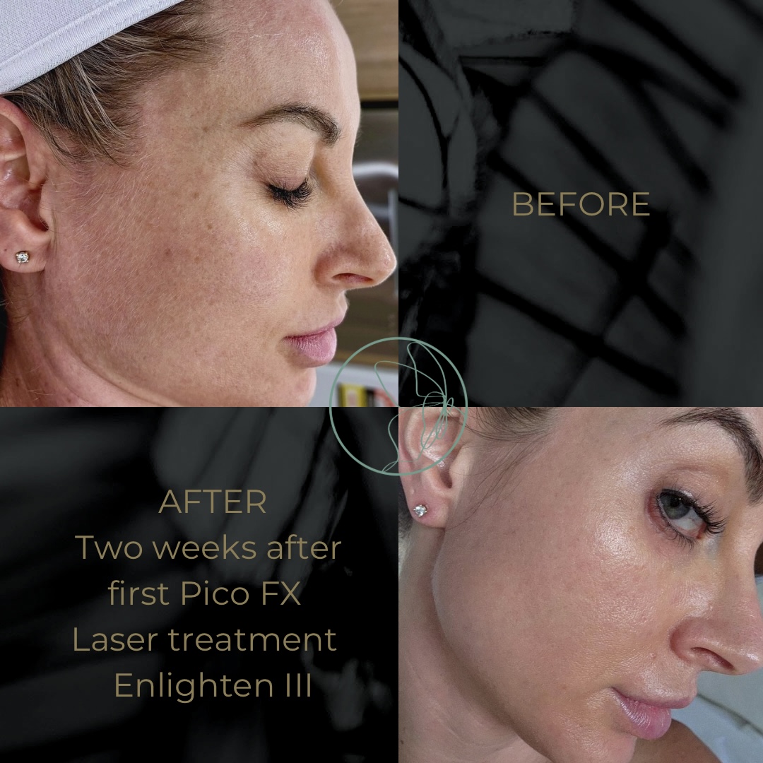 Skin Smoothening before and after at Glowtique Brisbane
