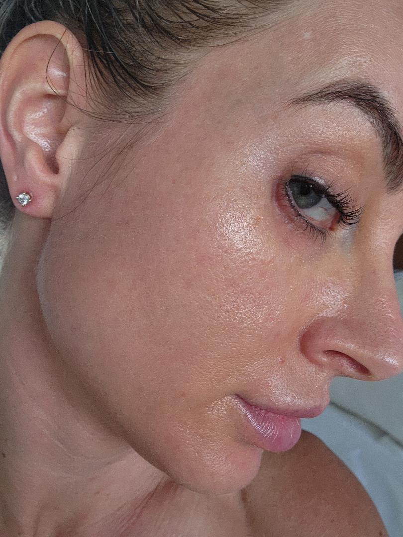 Skin Smoothening before and after at Glowtique Brisbane