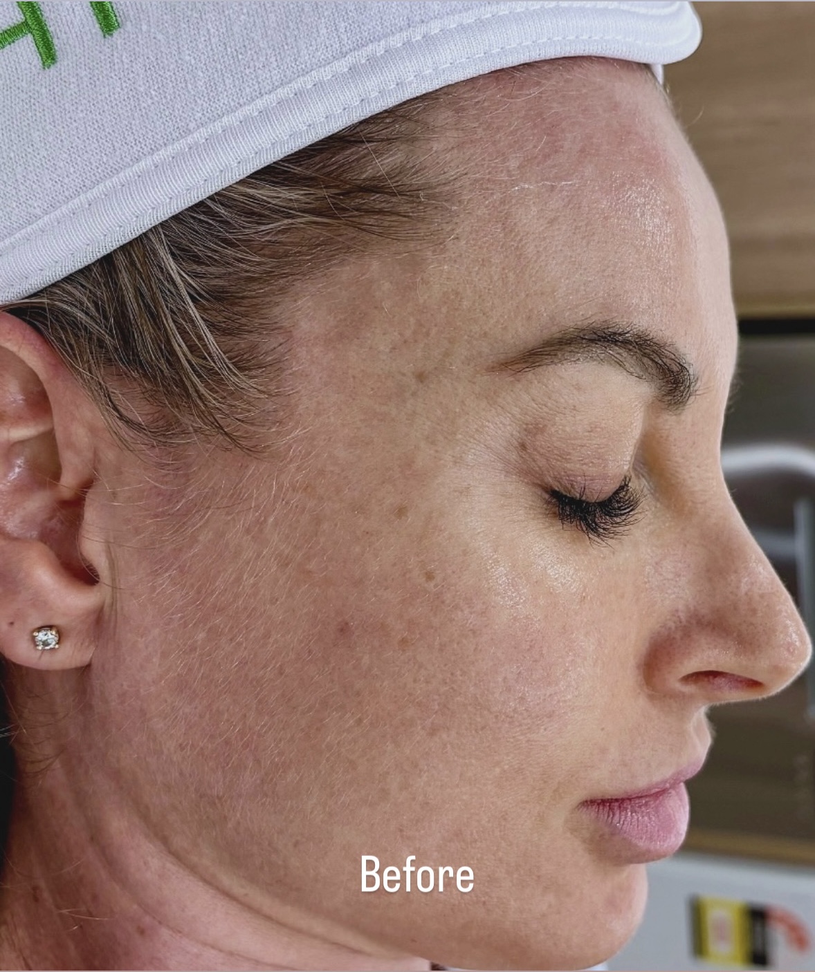 Skin Smoothening before and after at Glowtique Brisbane