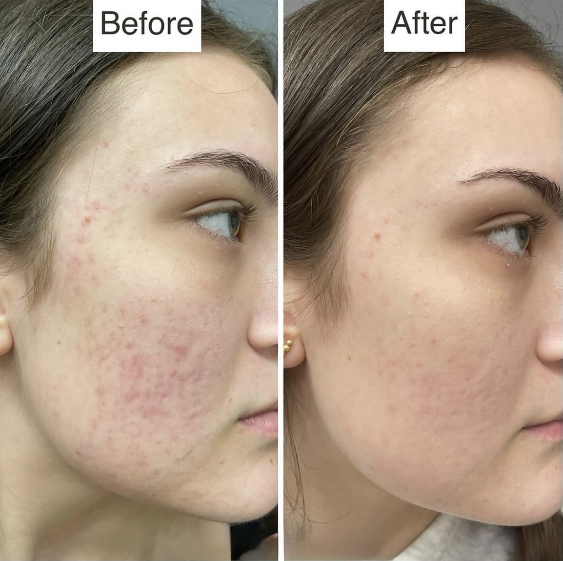 Skin Smoothening before and after at Glowtique Brisbane