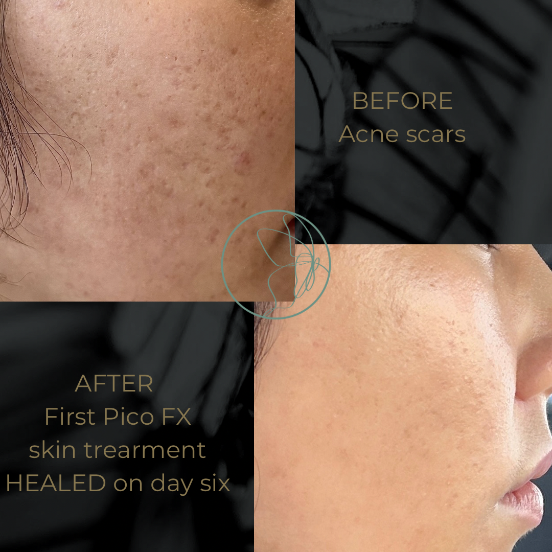 Skin Smoothening before and after at Glowtique Brisbane