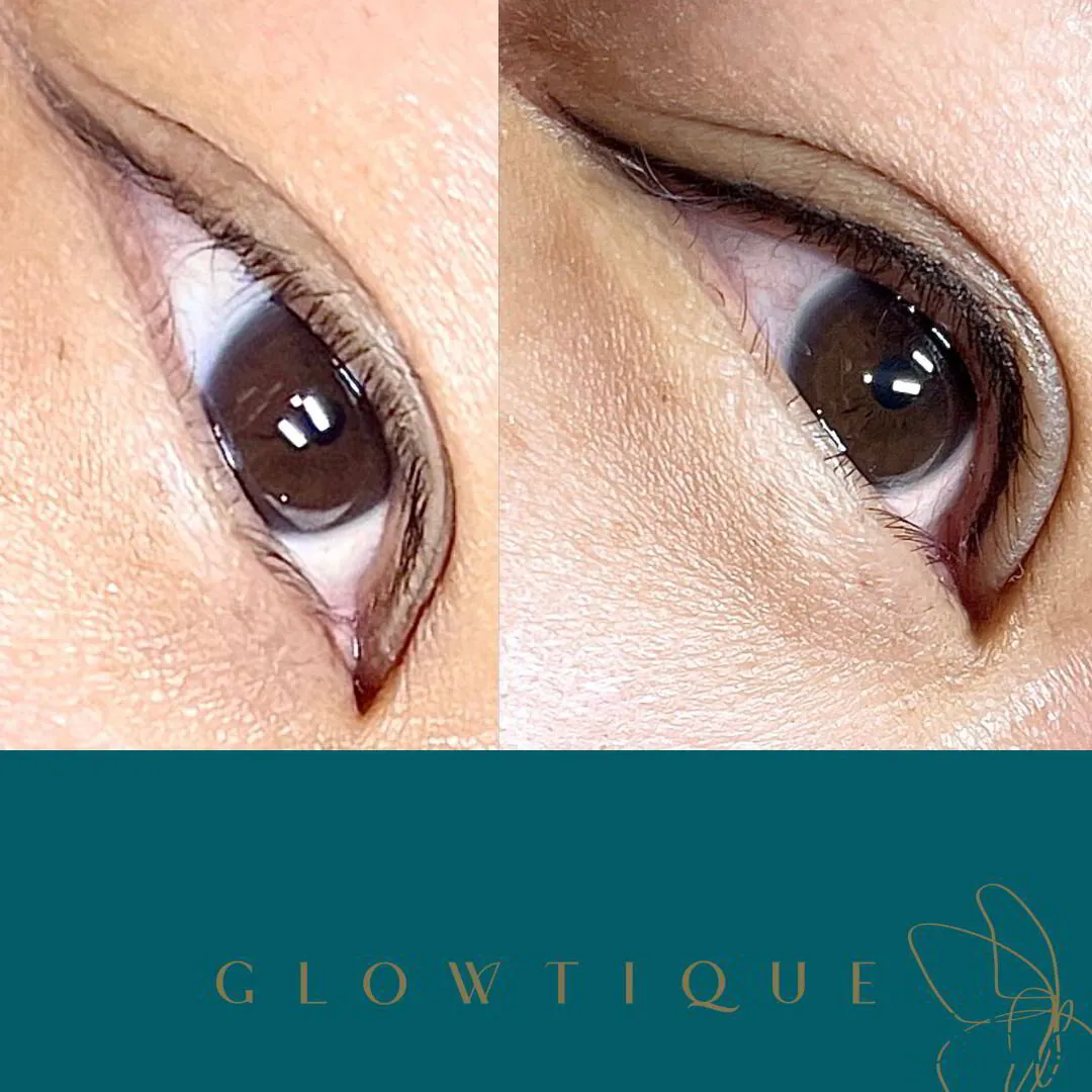 Upper Lid Eyeliner before and after at Glowtique Brisbane